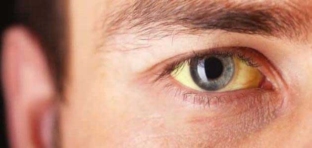 علت زردی چشم
