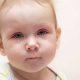 علت قی کردن چشم نوزاد