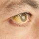 علت زرد شدن چشم